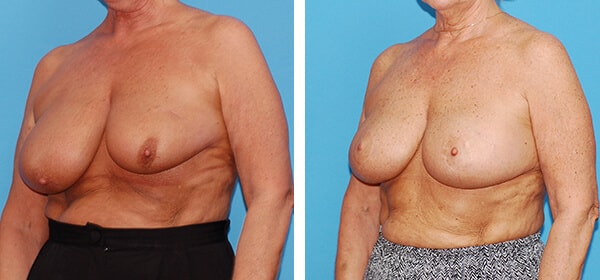 A result from Boulder Plastic Surgery