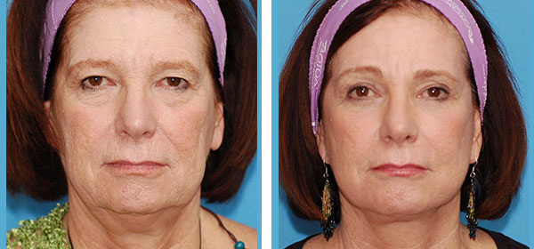 A result from Boulder Plastic Surgery