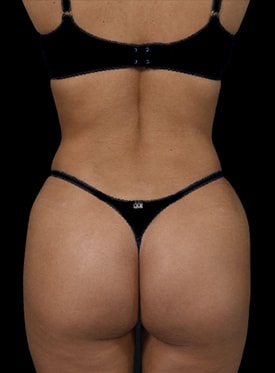 A result from Sunset Cosmetic Surgery