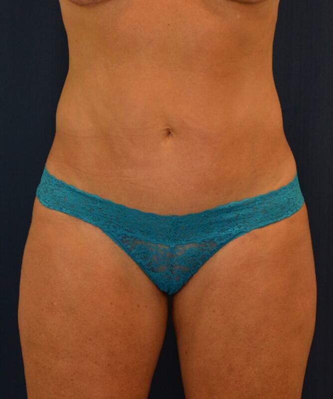 A result from Hass Plastic Surgery & MedSpa