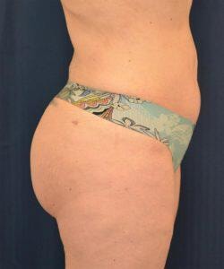 A result from Hass Plastic Surgery & MedSpa