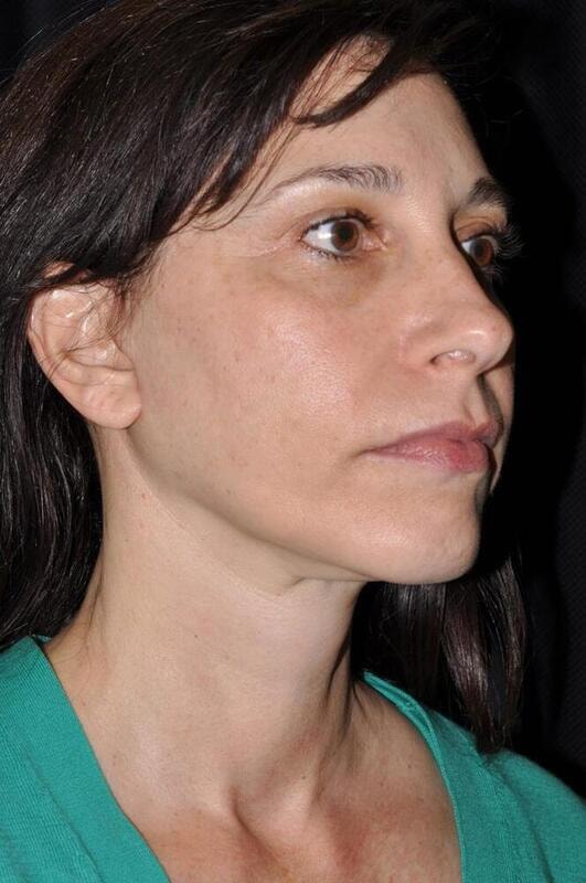 A result from Hass Plastic Surgery & MedSpa