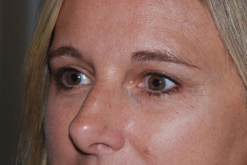 A result from Hass Plastic Surgery & MedSpa