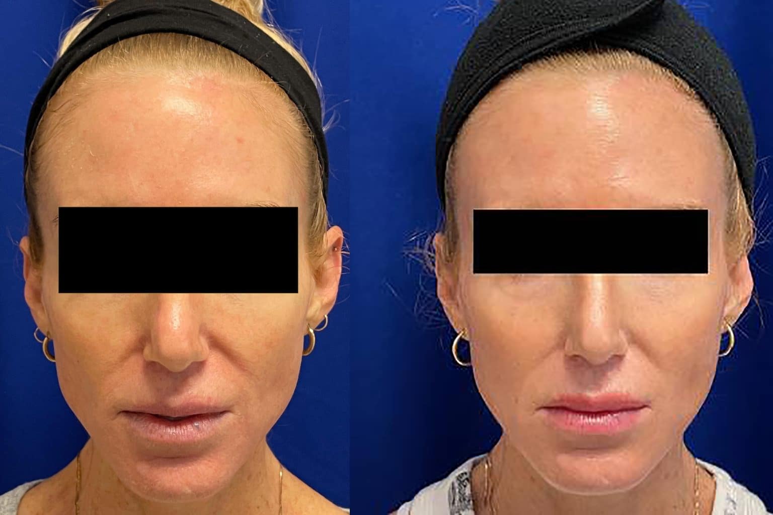 A result from Southlake Plastic Surgery