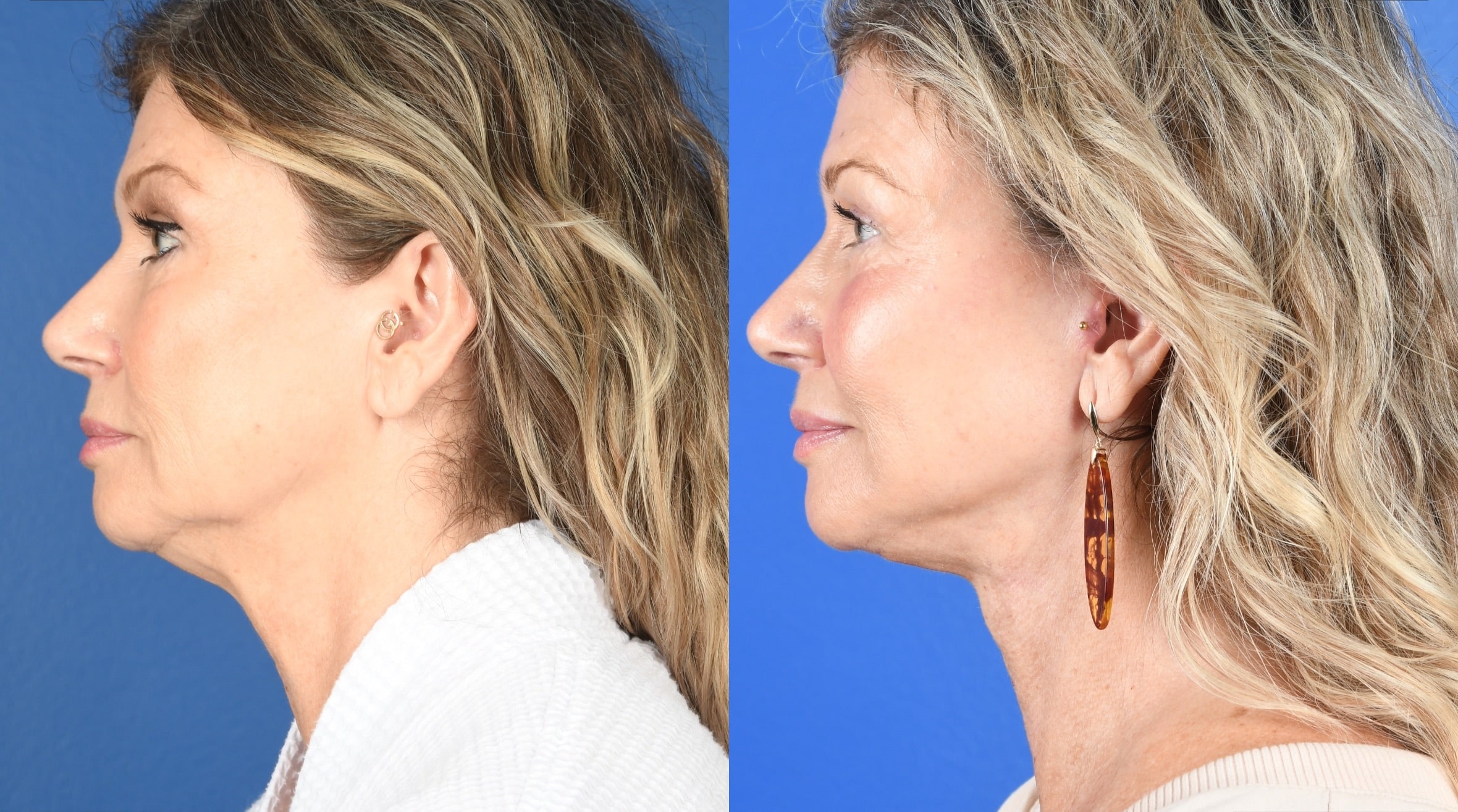 A result from Southlake Plastic Surgery