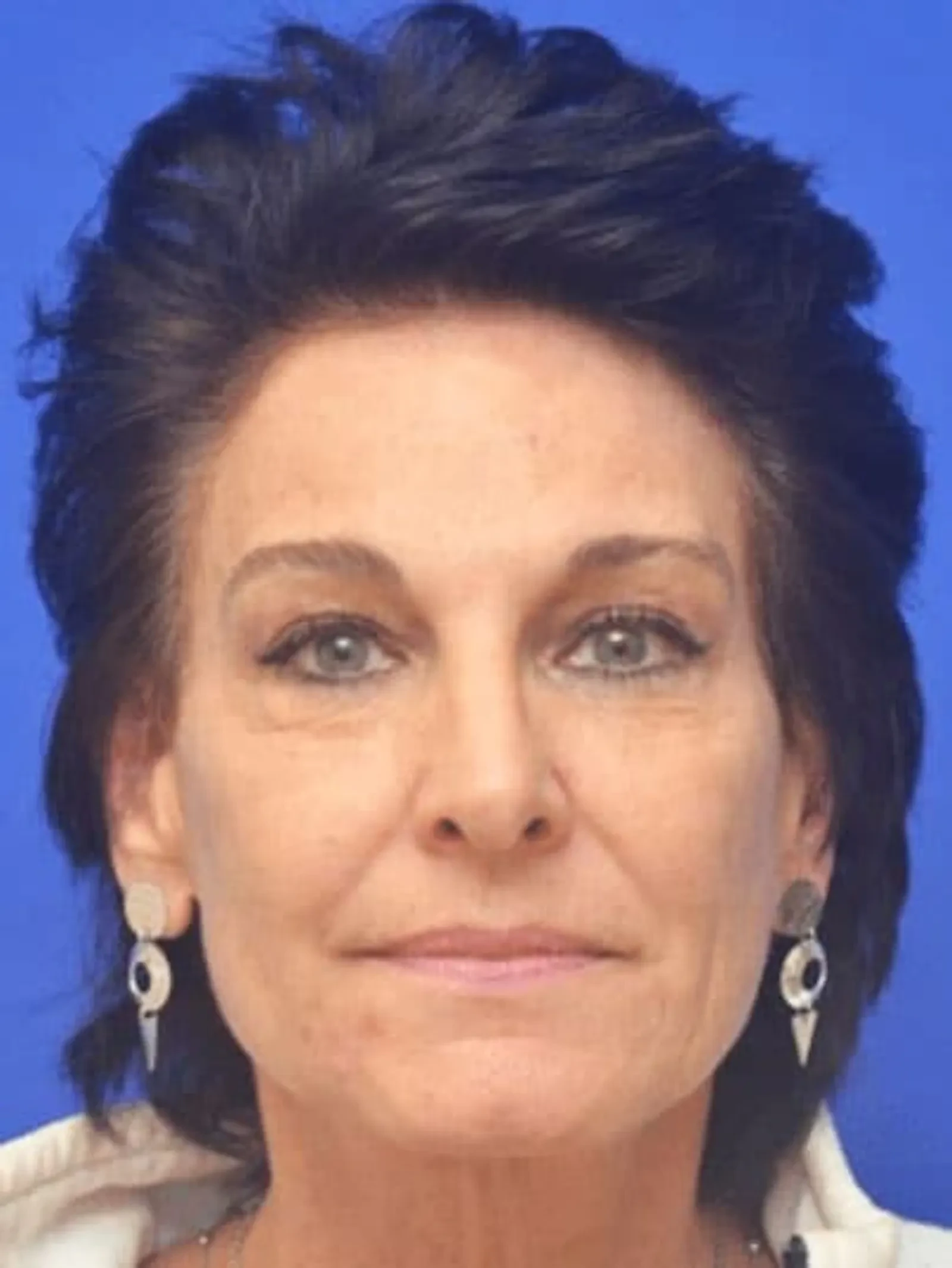 A result from Berman Plastic Surgery & Spa