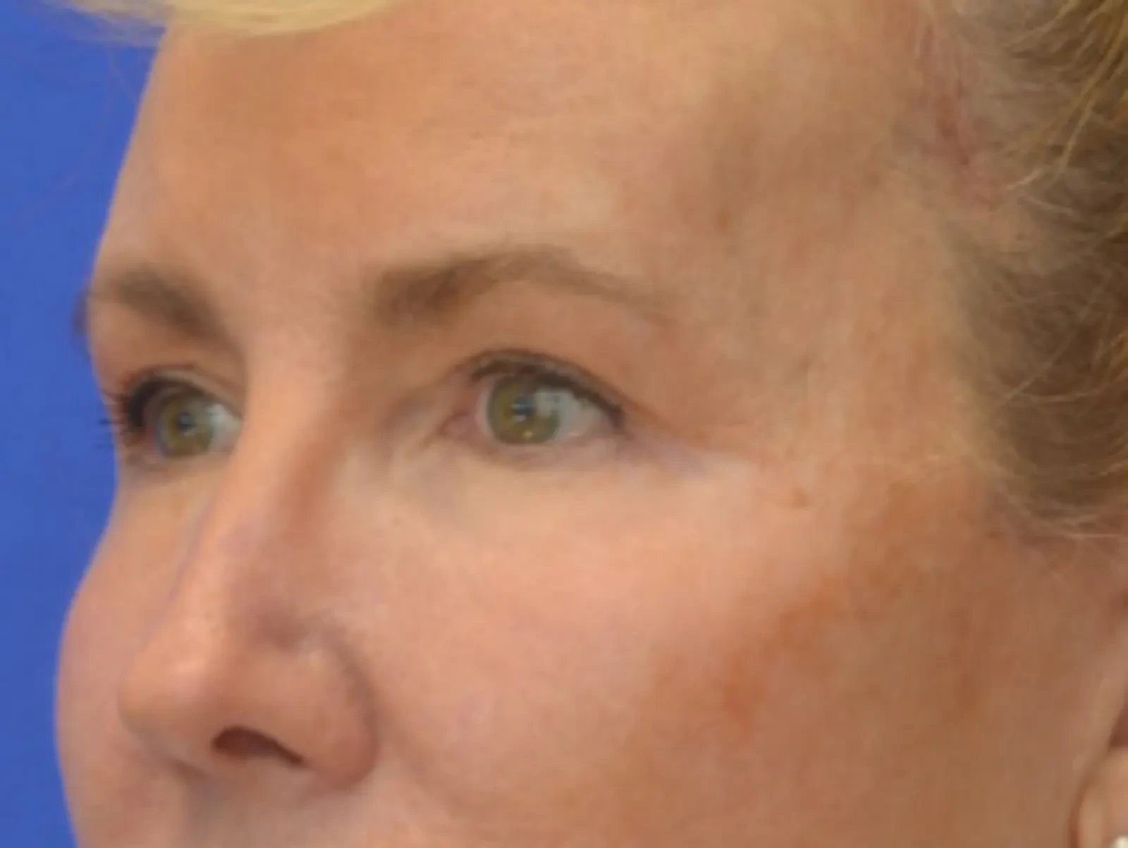 A result from Berman Plastic Surgery & Spa