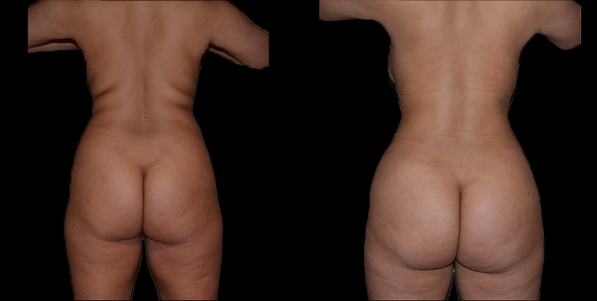 A result from Bellevue Plastic Surgeons