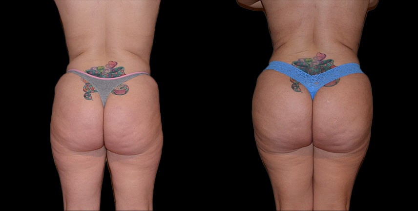 A result from Bellevue Plastic Surgeons