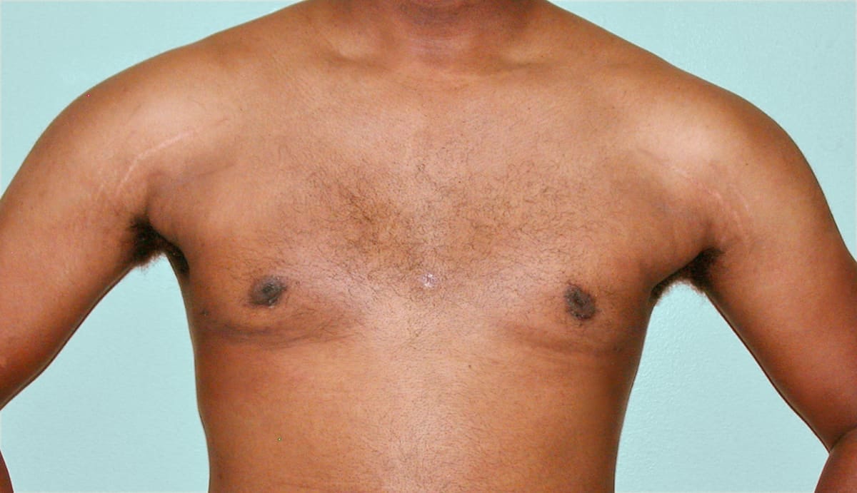 A result from Los Angeles Plastic Surgery