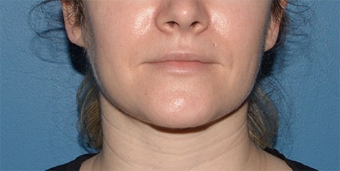 A result from RP Plastic Surgery