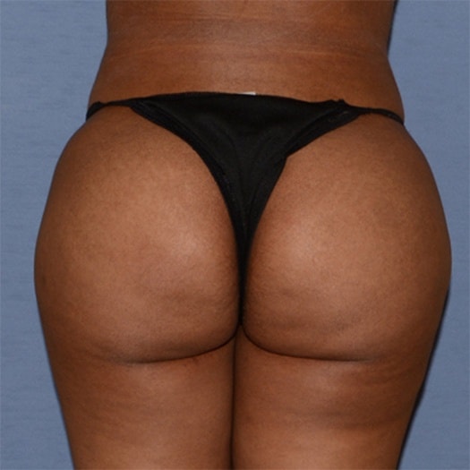 A result from RP Plastic Surgery