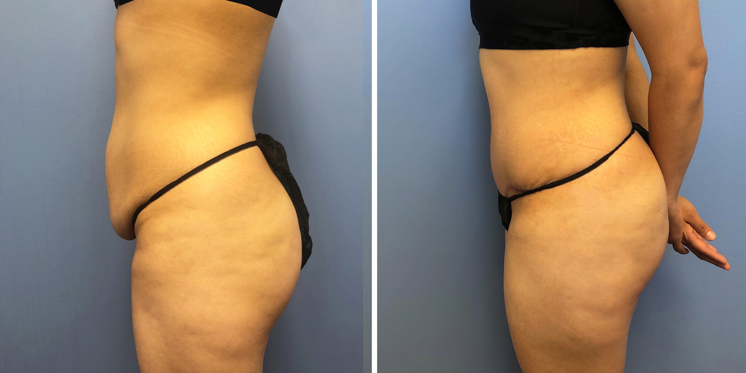 A result from Bluemont Plastic Surgery