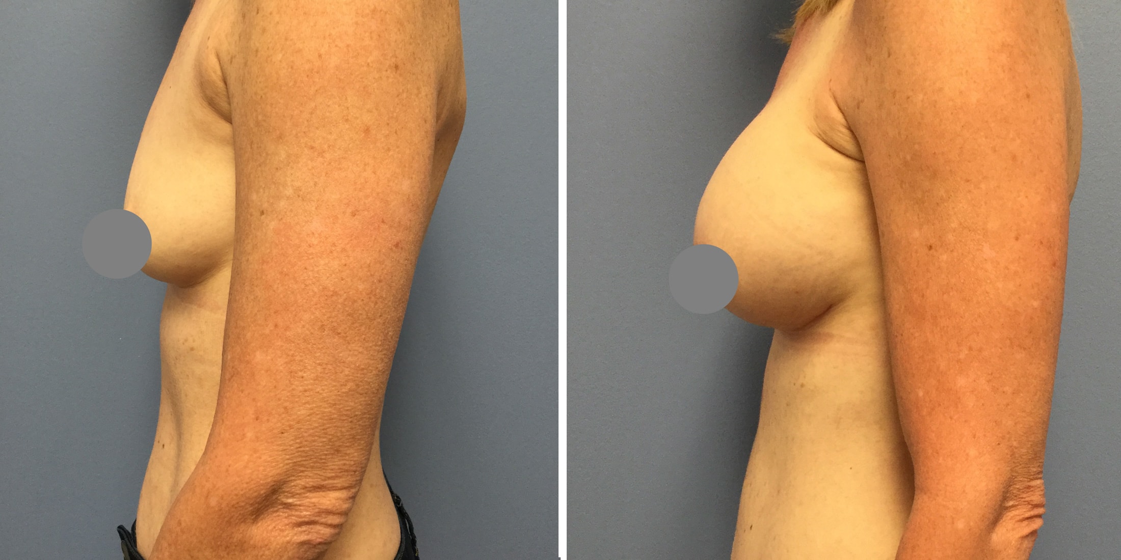 A result from Bluemont Plastic Surgery