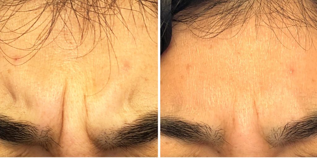 A result from Bluemont Plastic Surgery
