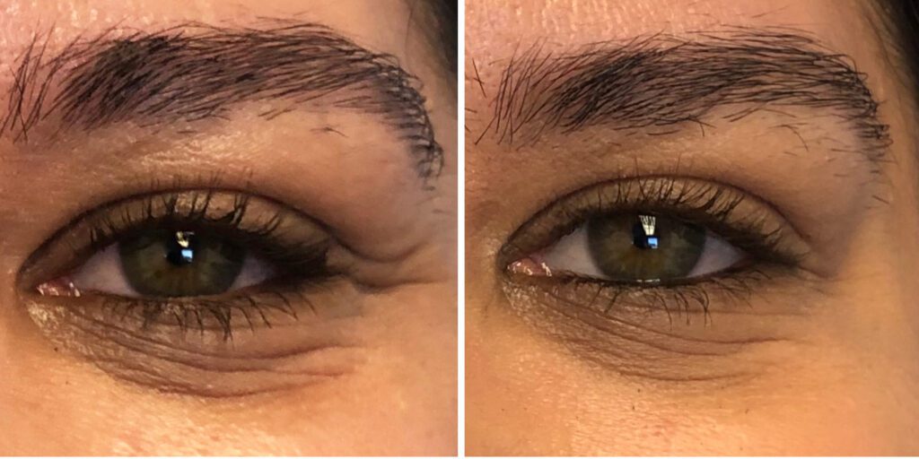 A result from Bluemont Plastic Surgery
