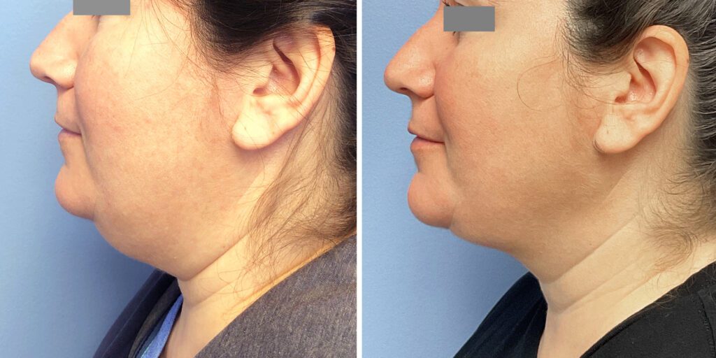 A result from Bluemont Plastic Surgery