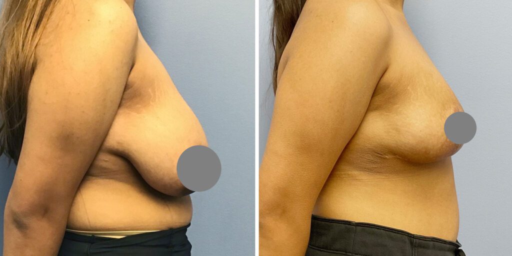 A result from Bluemont Plastic Surgery