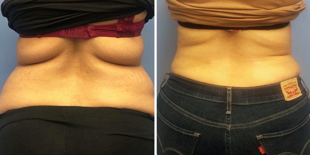 A result from Bluemont Plastic Surgery