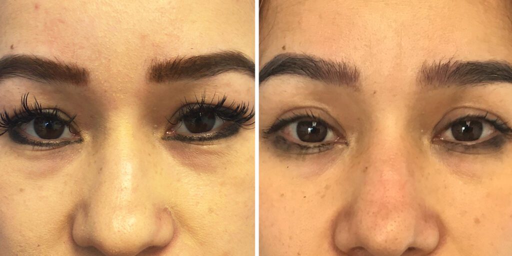 A result from Bluemont Plastic Surgery