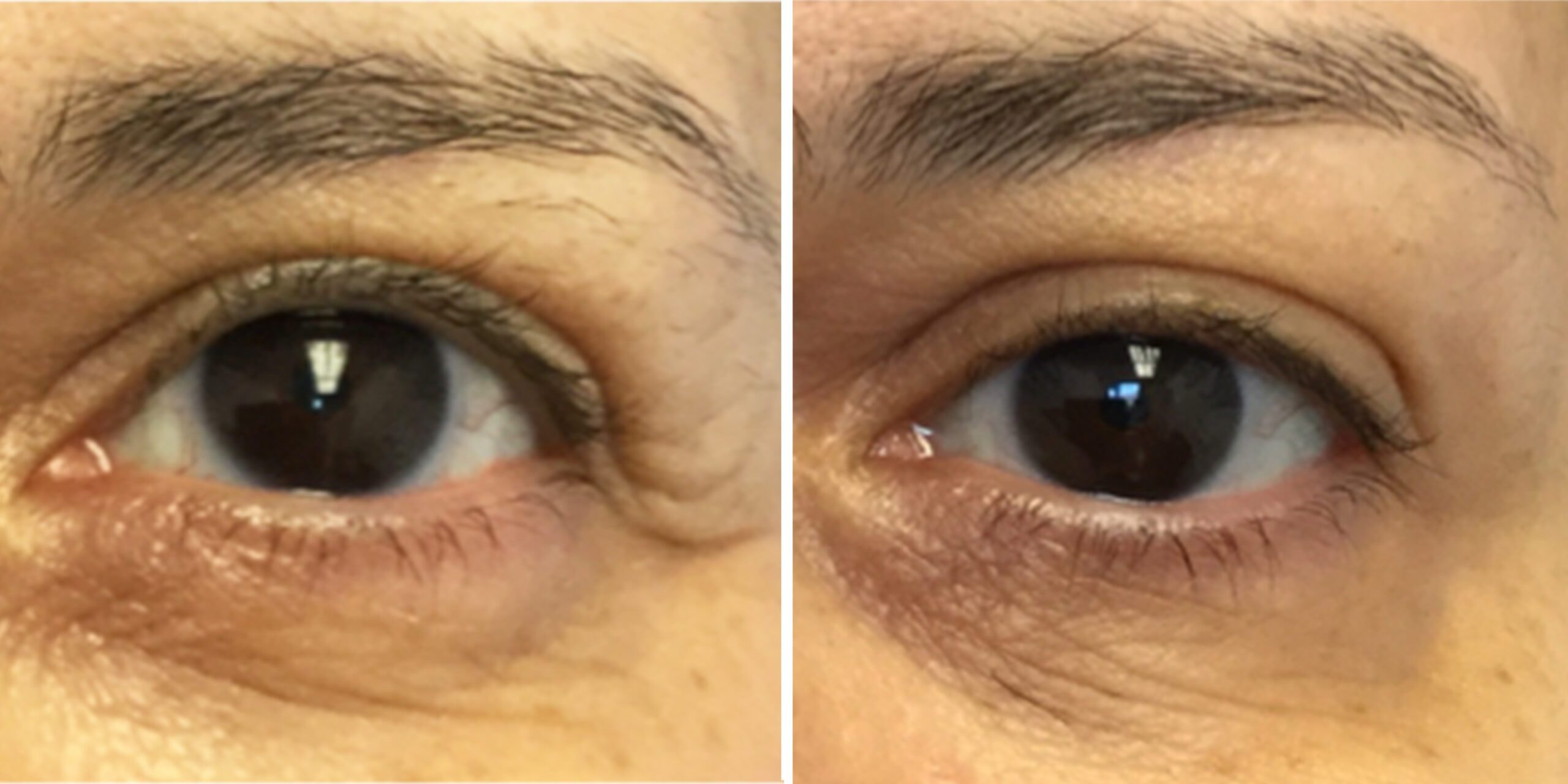 A result from Bluemont Plastic Surgery