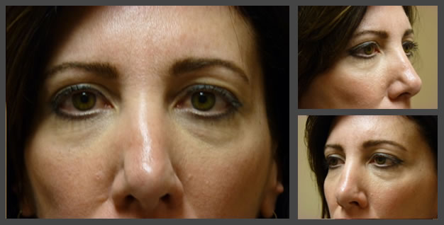 Plastic Surgery for Eyes cheek filler after — Sandy, UT