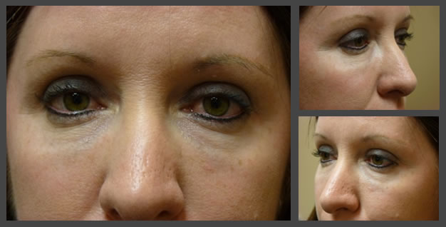 Plastic Surgery for Eyes cheek filler after — Sandy, UT