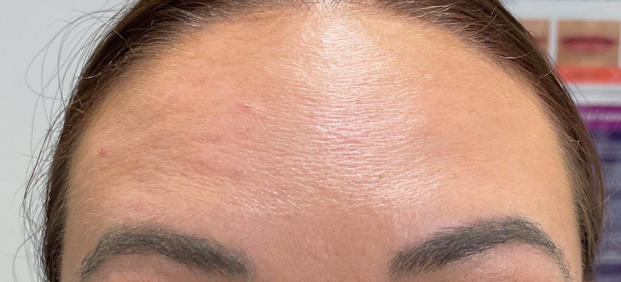 A result from San Diego Aesthetics and Med Spa