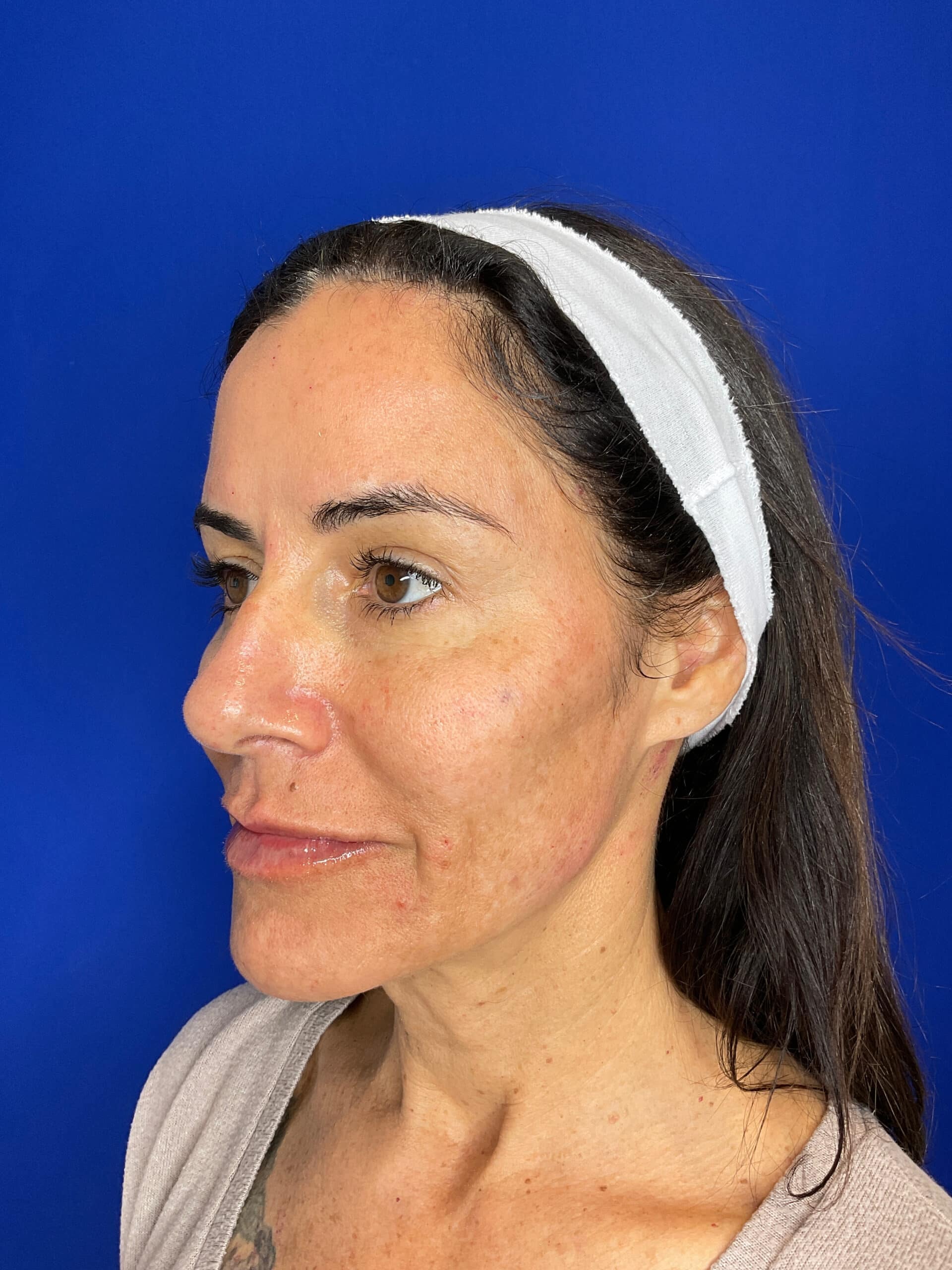 A result from San Diego Aesthetics and Med Spa