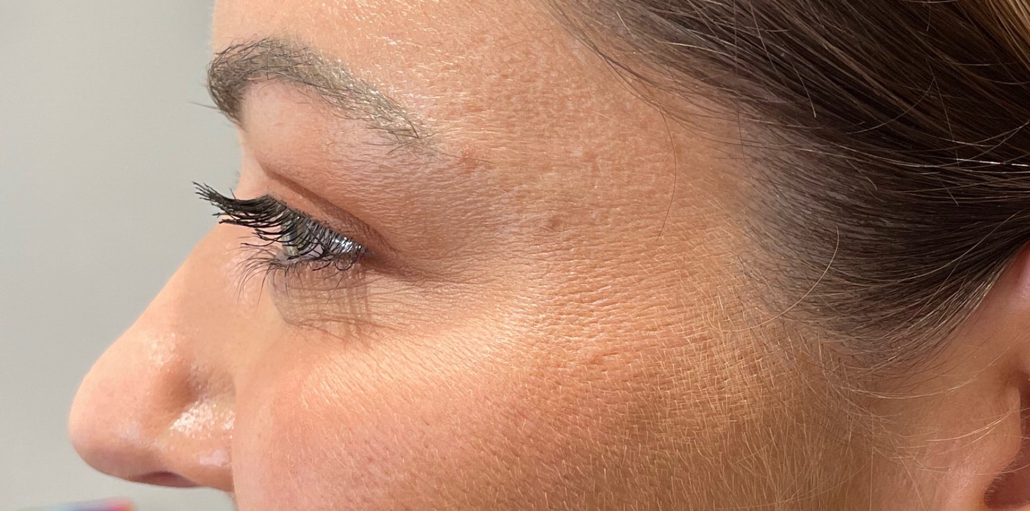 A result from San Diego Aesthetics and Med Spa