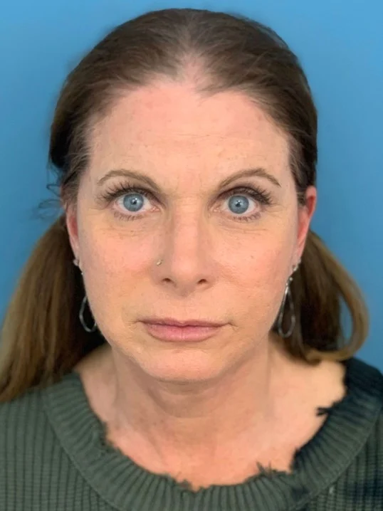 Facelift result at Dr. Suzanne A. Trott, M.D., F.A.C.S. - Beverly Hills Plastic Surgeon