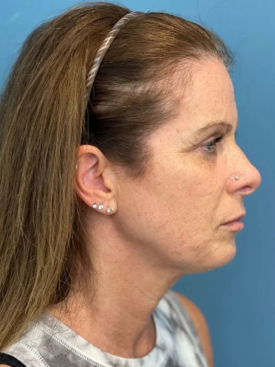 Facelift result at Dr. Suzanne A. Trott, M.D., F.A.C.S. - Beverly Hills Plastic Surgeon