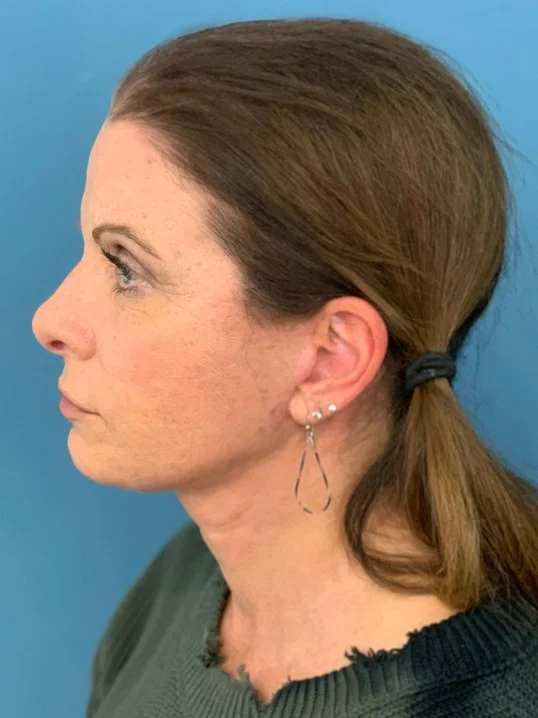 Facelift result at Dr. Suzanne A. Trott, M.D., F.A.C.S. - Beverly Hills Plastic Surgeon