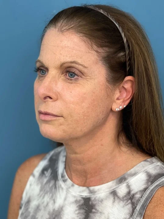 Facelift result at Dr. Suzanne A. Trott, M.D., F.A.C.S. - Beverly Hills Plastic Surgeon