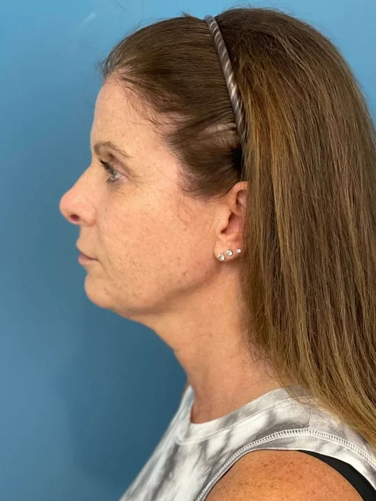 Facelift result at Dr. Suzanne A. Trott, M.D., F.A.C.S. - Beverly Hills Plastic Surgeon
