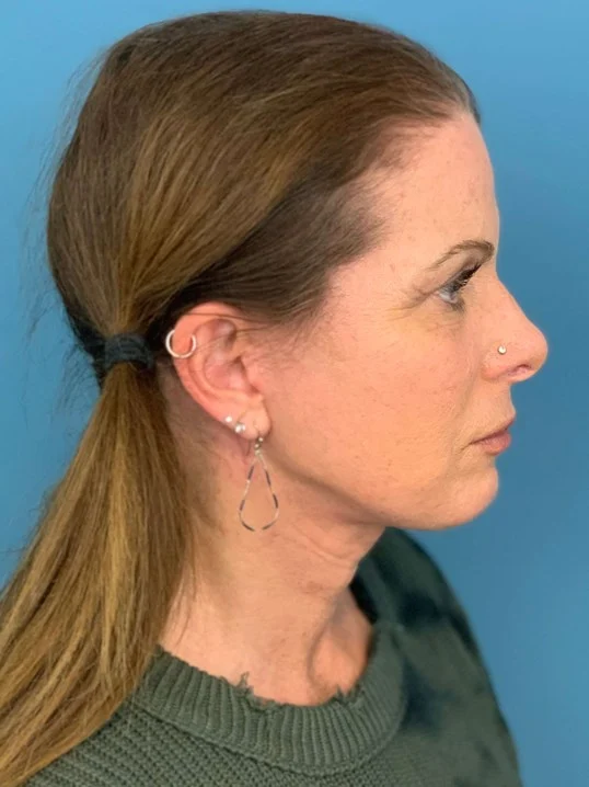 Facelift result at Dr. Suzanne A. Trott, M.D., F.A.C.S. - Beverly Hills Plastic Surgeon