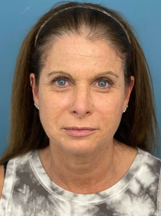 Facelift result at Dr. Suzanne A. Trott, M.D., F.A.C.S. - Beverly Hills Plastic Surgeon