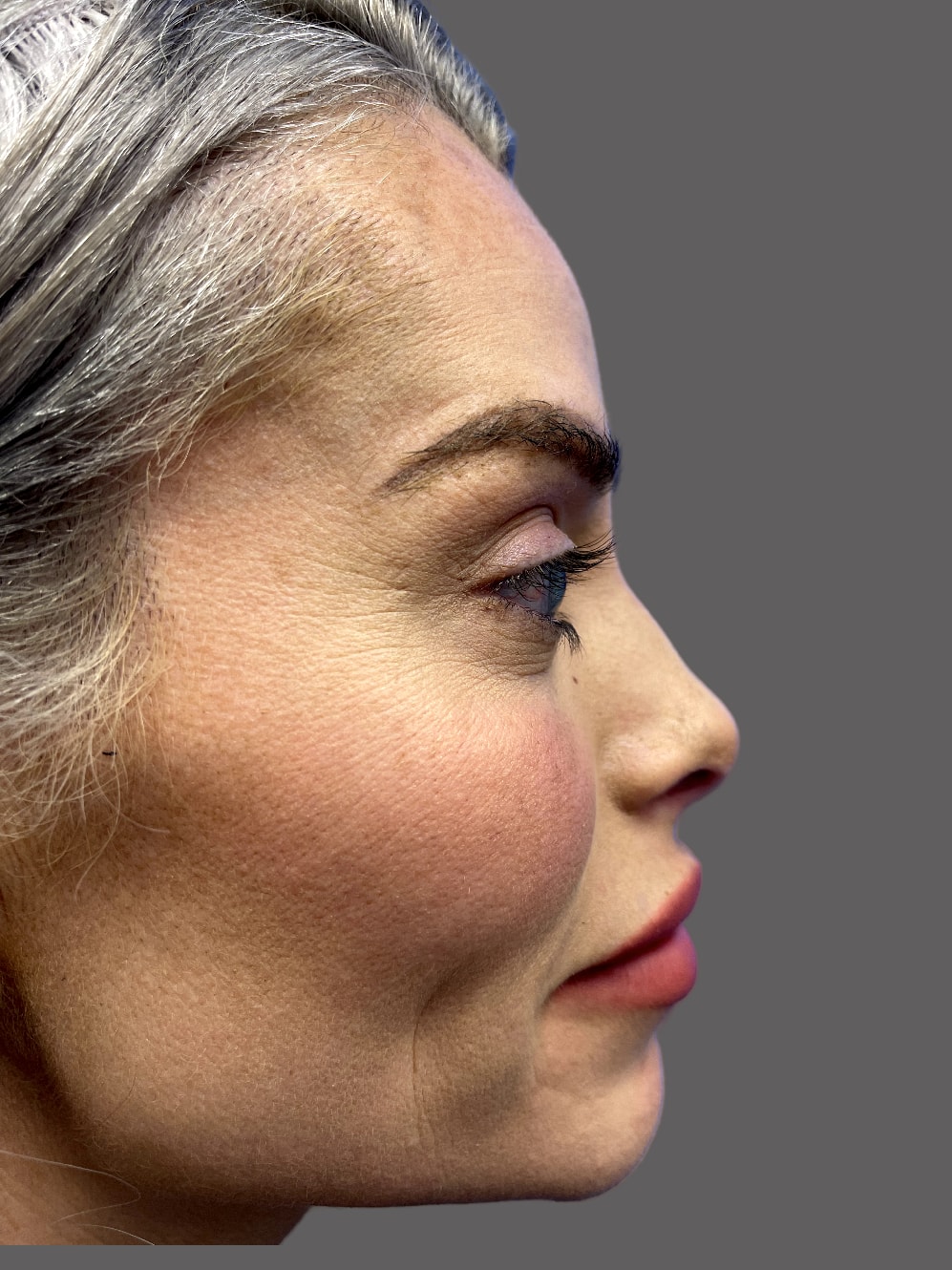 A result from Kadz Plastic Surgery