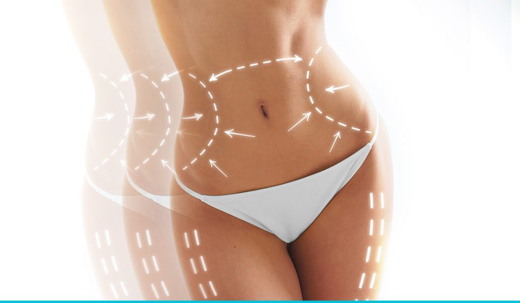 Liposuction result at Dr. Kalantarian Plastic Surgery