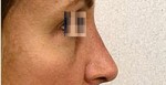 Rhinoplasty result at Dr. Kalantarian Plastic Surgery