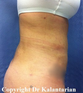 Bbl result at Dr. Kalantarian Plastic Surgery