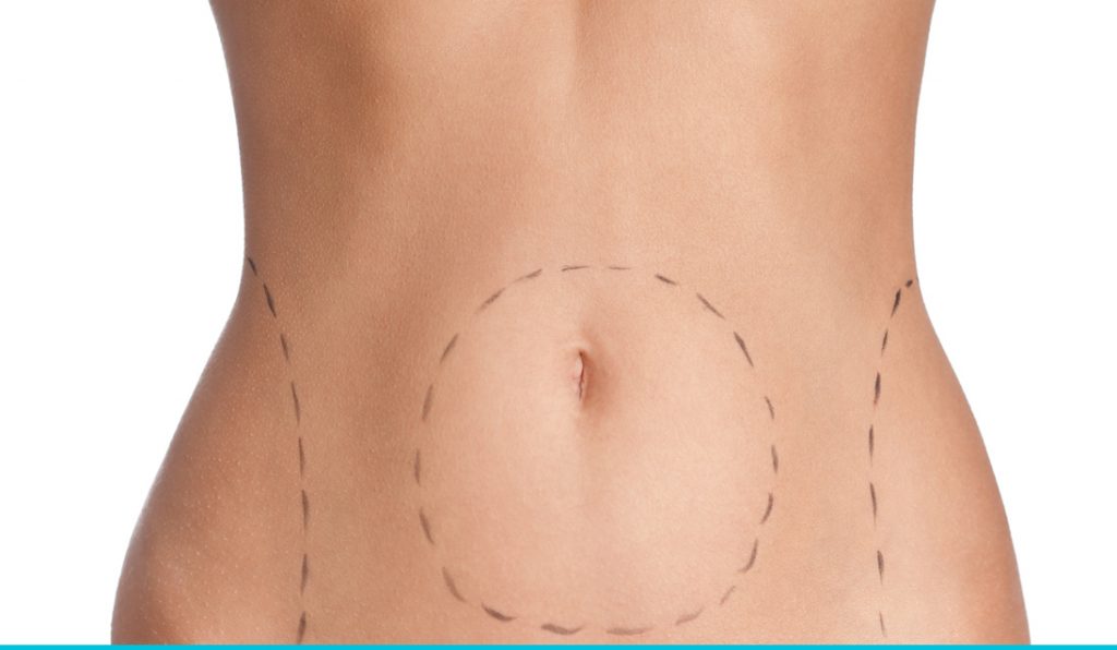 Tummy Tuck result at Dr. Kalantarian Plastic Surgery