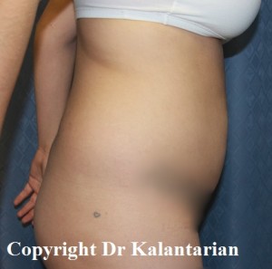 Bbl result at Dr. Kalantarian Plastic Surgery
