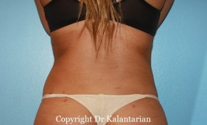 Liposuction result at Dr. Kalantarian Plastic Surgery