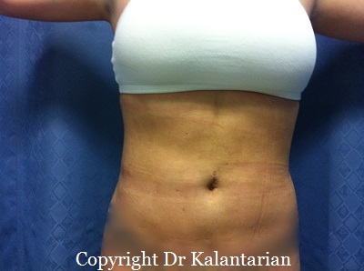 Bbl result at Dr. Kalantarian Plastic Surgery
