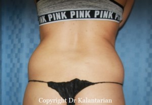 Liposuction result at Dr. Kalantarian Plastic Surgery