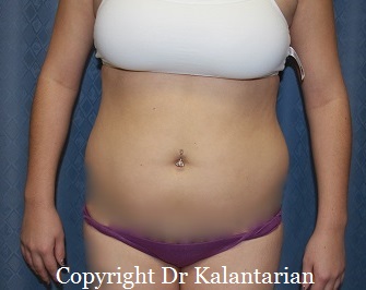 Bbl result at Dr. Kalantarian Plastic Surgery