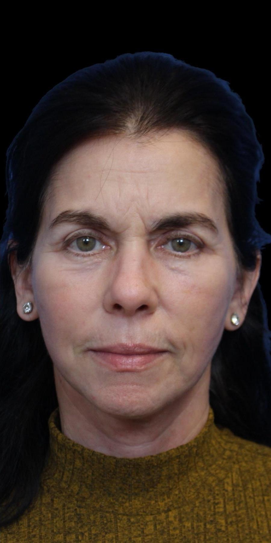 A result from Aeris Plastic Surgery