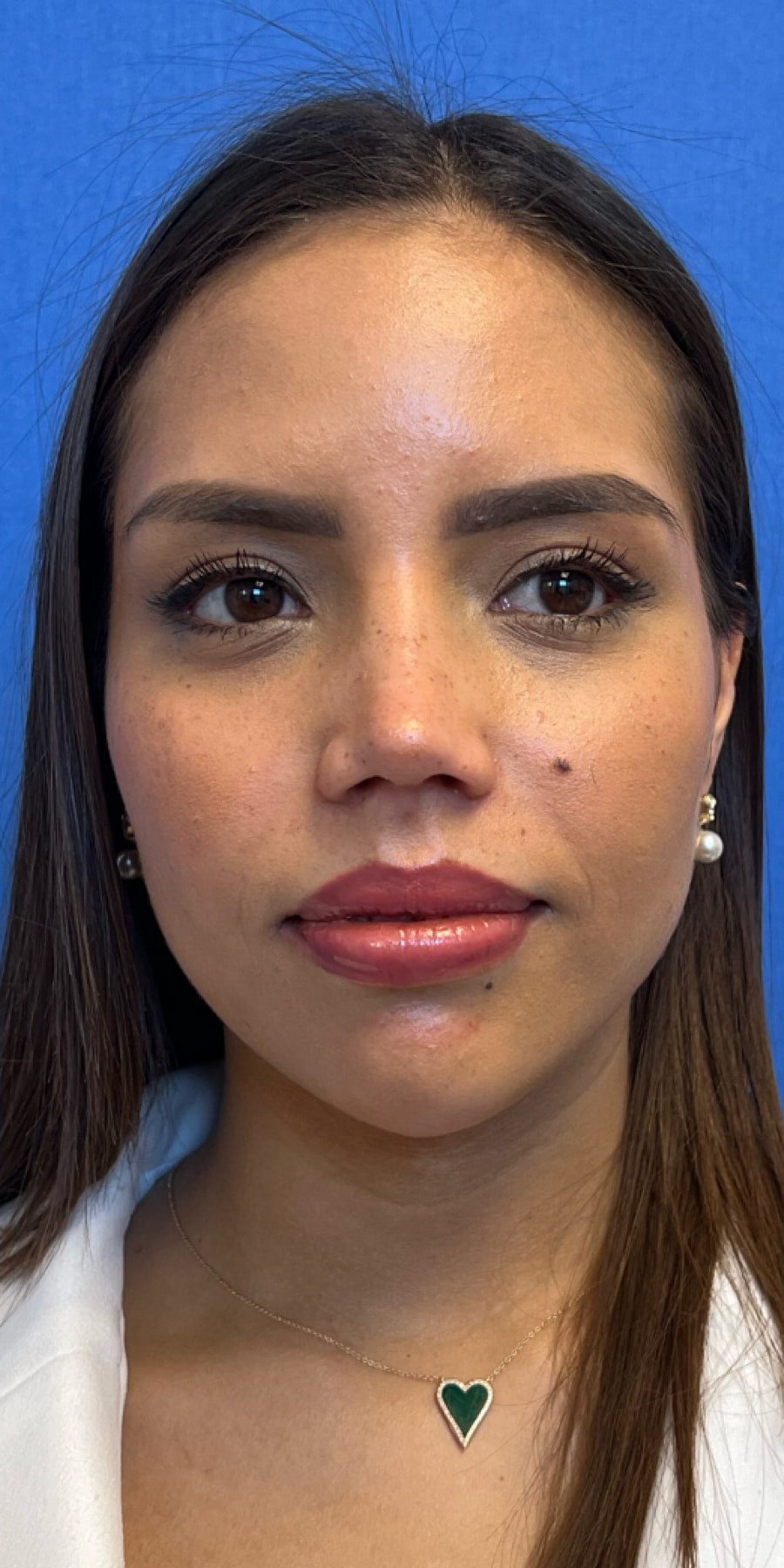 A result from Aeris Plastic Surgery
