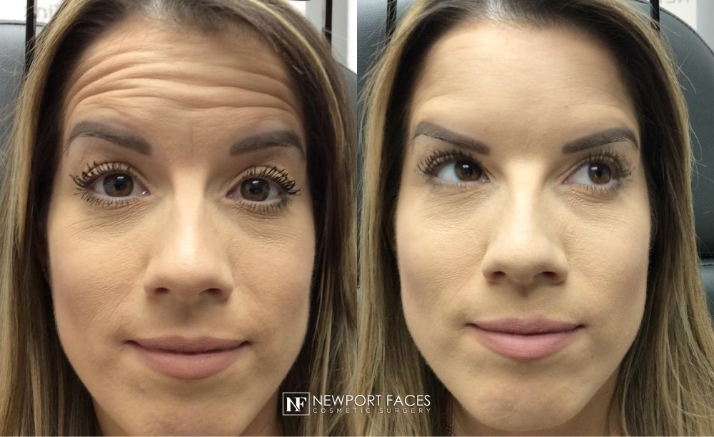 A result from Newport Faces Cosmetic Surgery